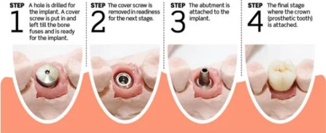 Dental implant procedure in North Ryde