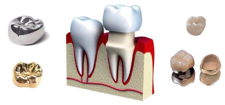 Dental crowns in Macquarie Park