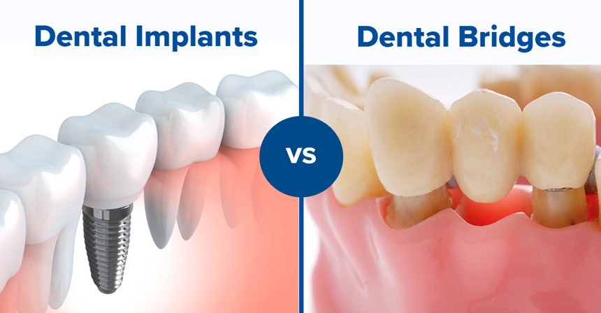 tooth implant vs bridge in Macquarie Park