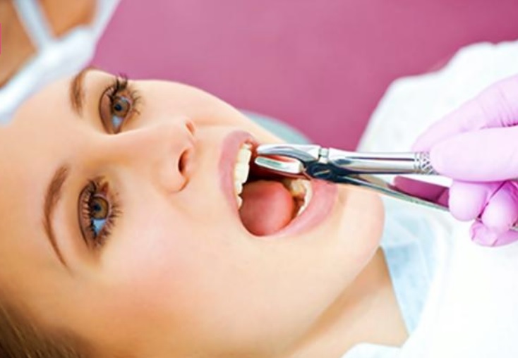 Wisdom teeth removal in Macquarie Park