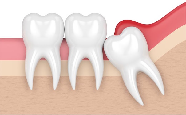 Wisdom teeth removal in Macquarie Park