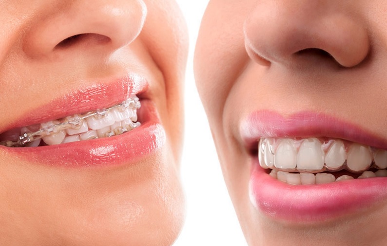 Invisalign vs braces cost in North Ryde