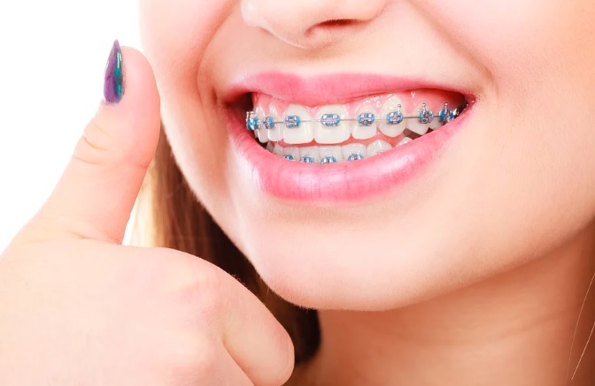 braces cost in North Ryde