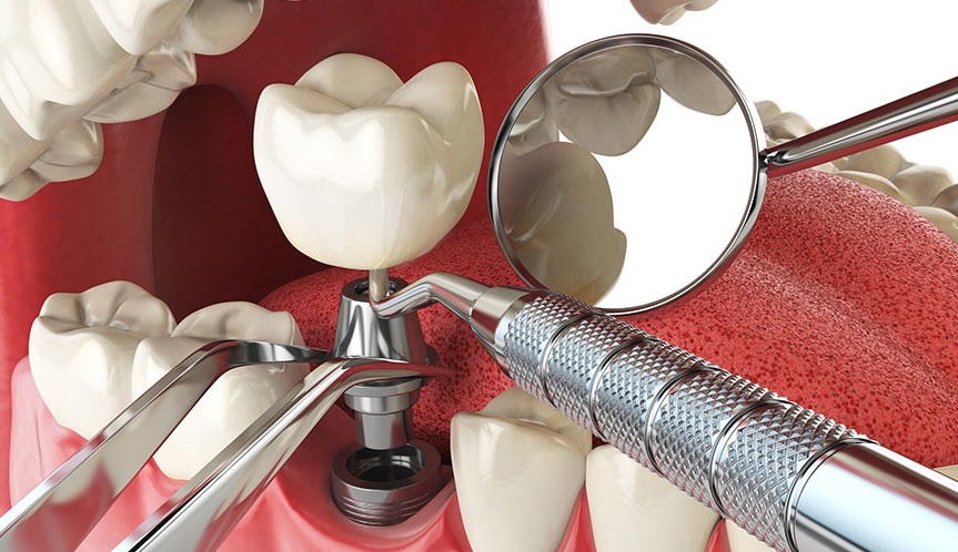 durability of dental implants in North Ryde