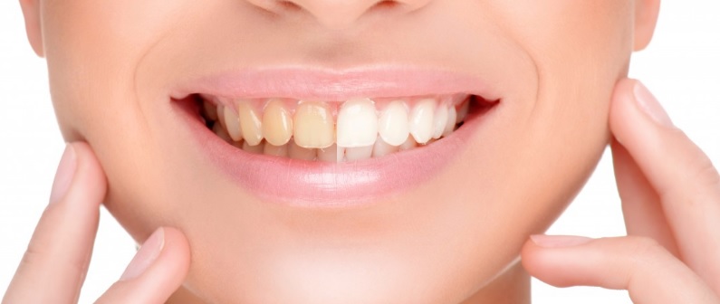 teeth whitening in North Ryde