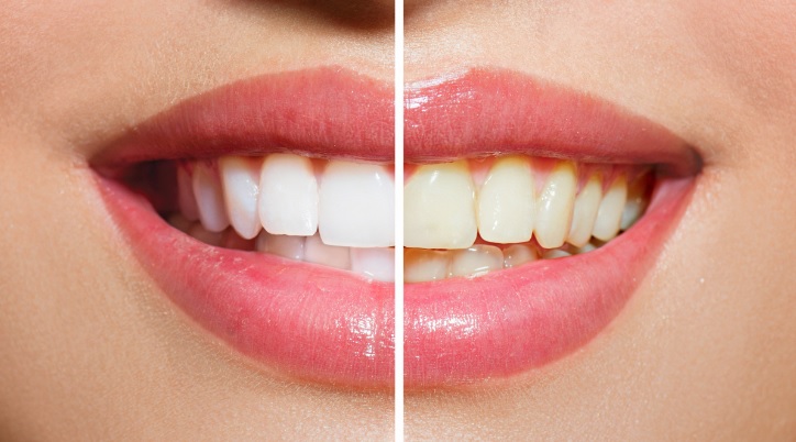 Teeth Whitening in North Ryde