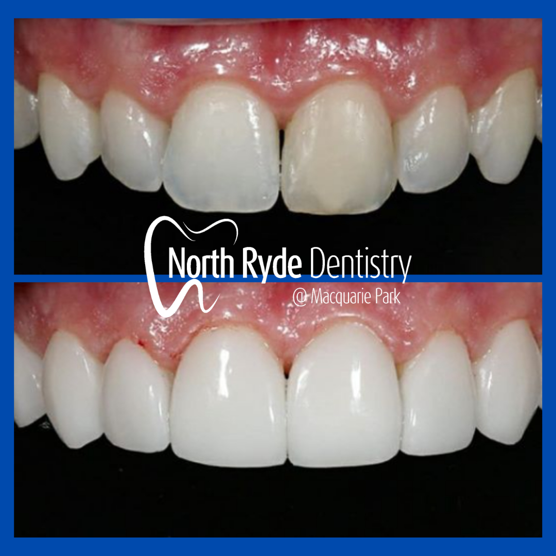 Emax BL3-LT by North Ryde Denistry