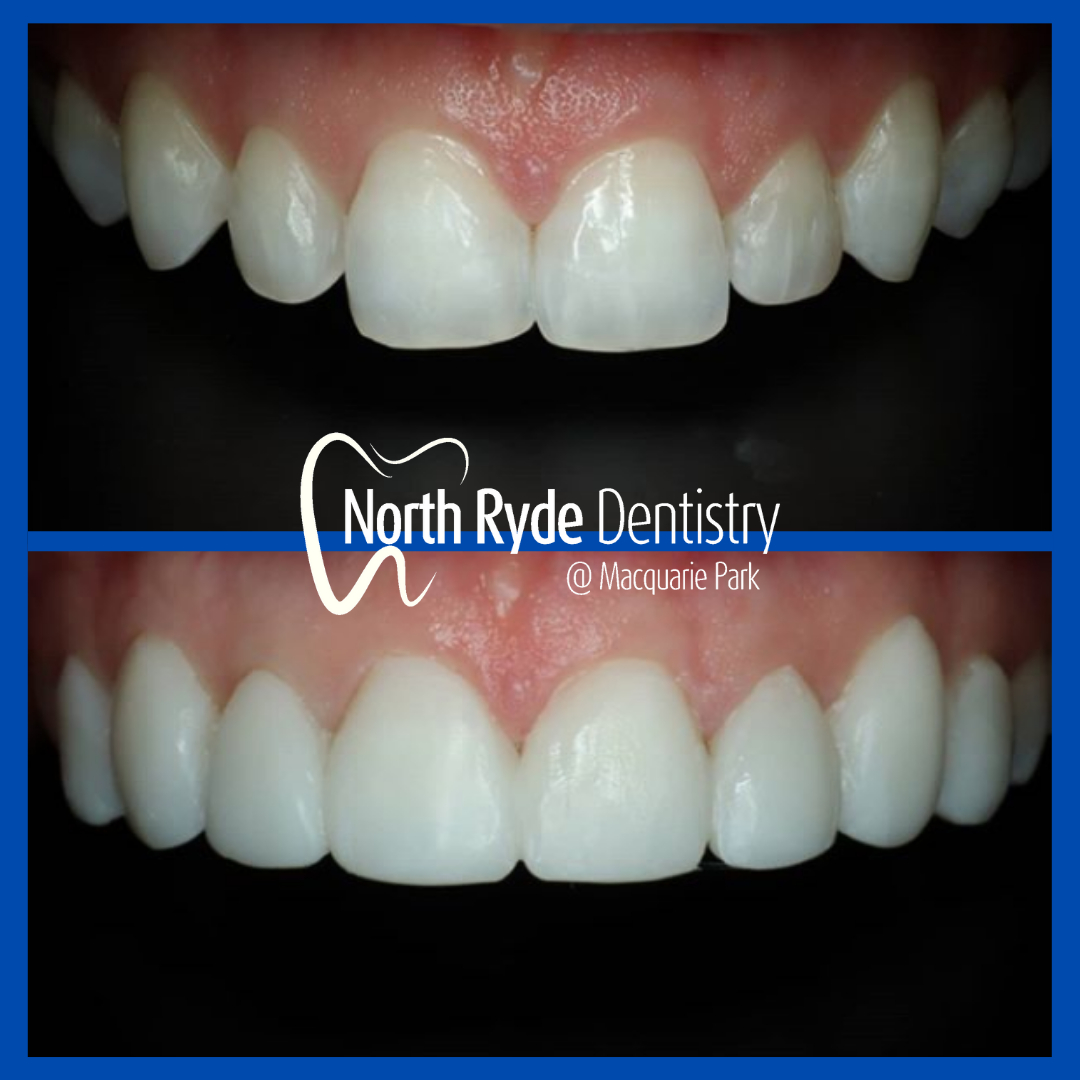 Estelite BW direct temporary veneers