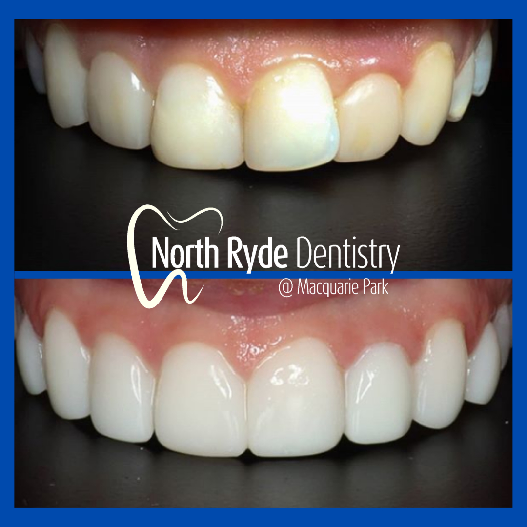 Estelite Sigma BW composite veneers by North Ryde Dentistry in Macquarie Park