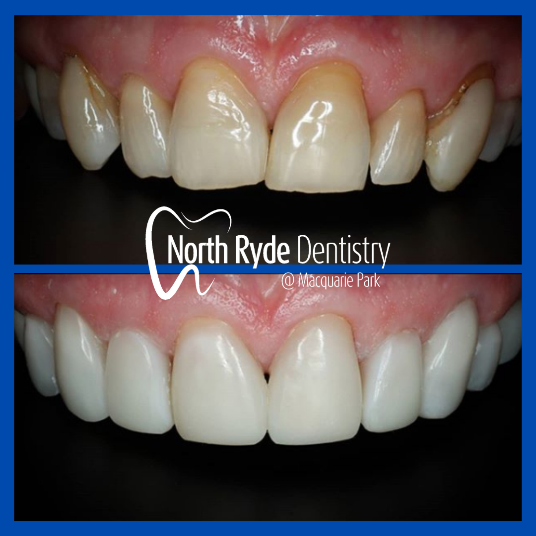Herculite Flow XL2 by North Ryde Dentistry