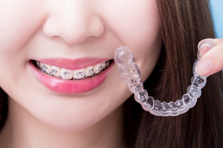 Braces Cost