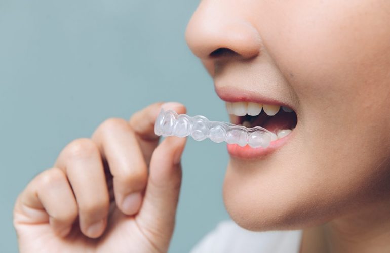 Invisalign Sydney