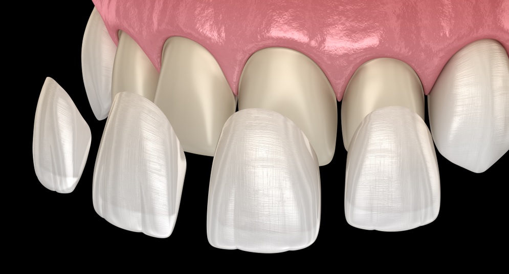 Porcelain Veneers Sydney