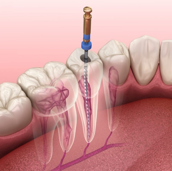 Root Canal Cost