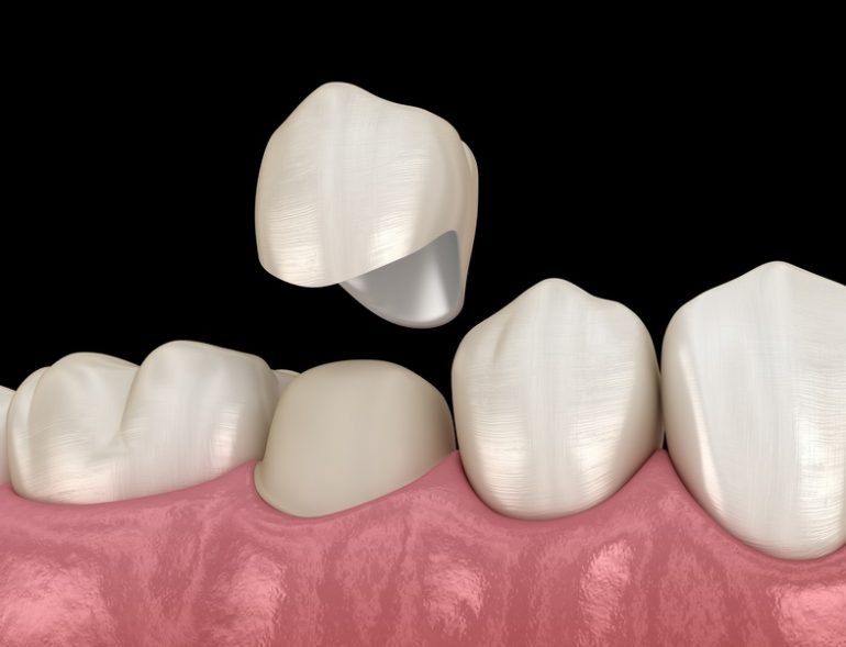 Dental Crowns Sydney North Ryde Dentistry