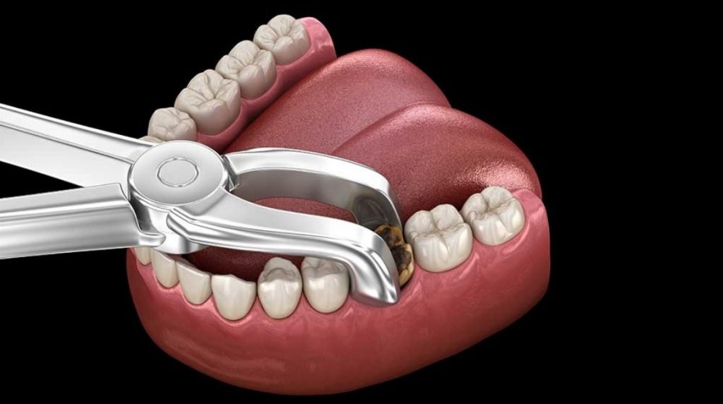 Tooth Extraction Cost North Ryde Dentistry