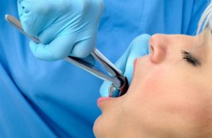 Tooth Extraction Cost