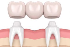 Tooth Bridge