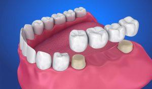 Dental Bridge Cost