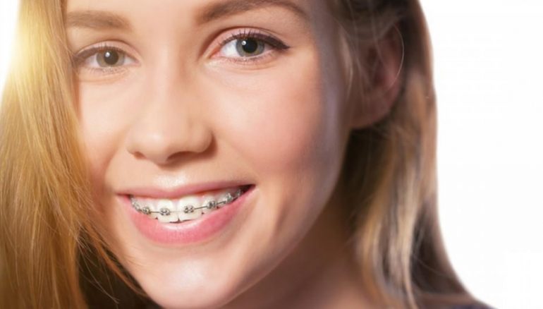 How Much Do Braces Cost North Ryde Dentistry 