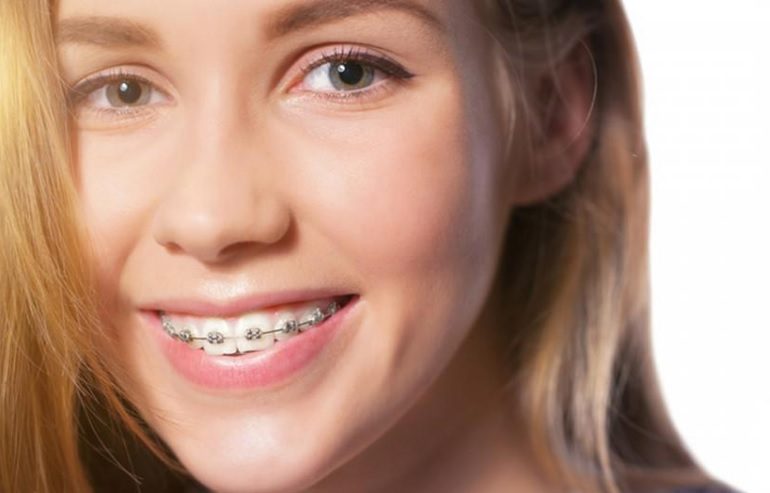 How much do braces cost