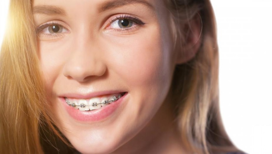 How much do braces cost