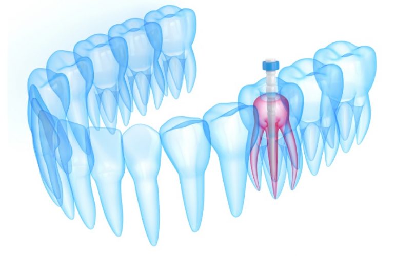 Root Canal Treatment Cost