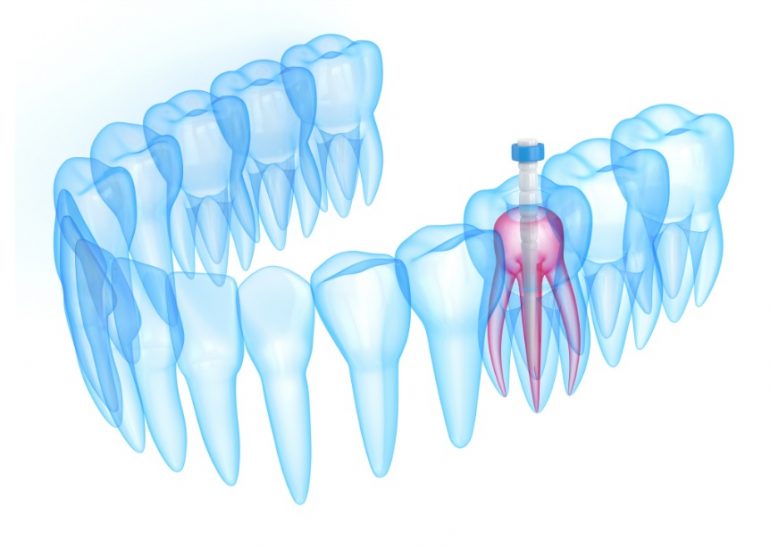 Root Canal Treatment Cost North Ryde Dentistry