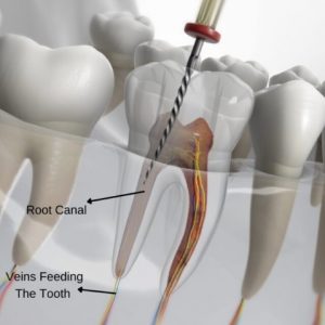 Root Canal Treatment Cost