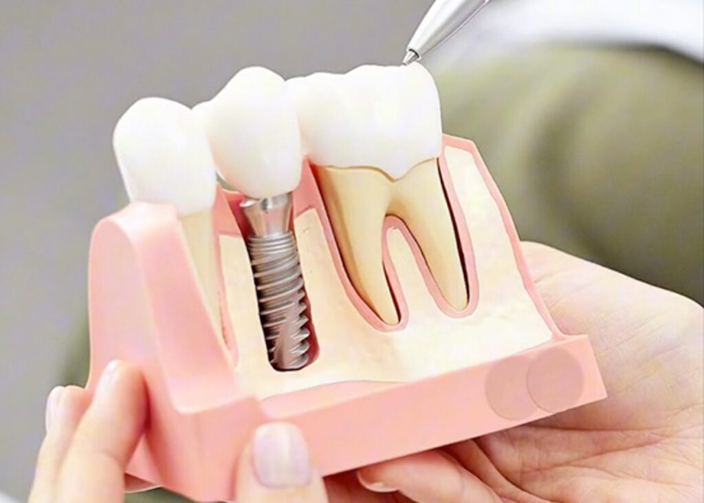 How much are dental implants?