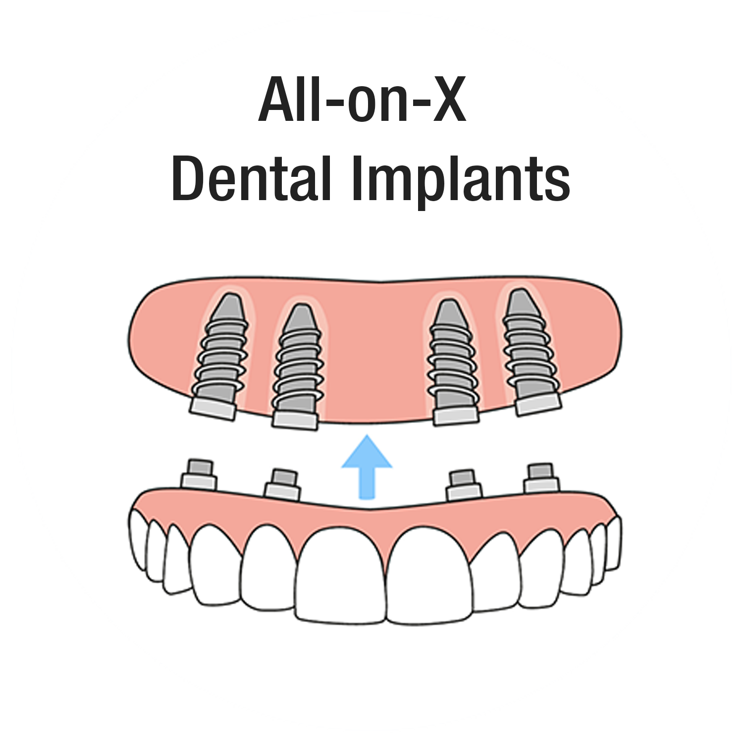 All-On-X Dental Implants