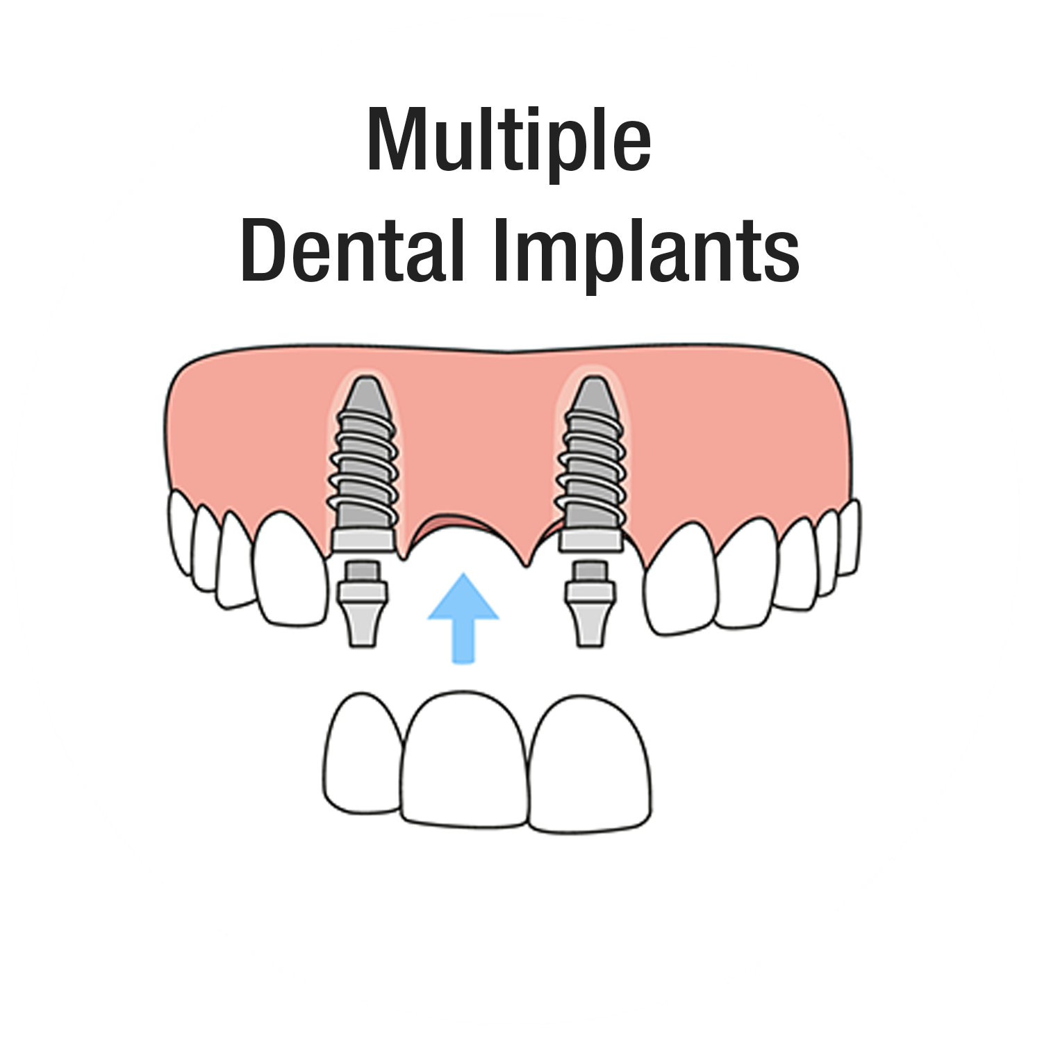 Multiple Dental Implants