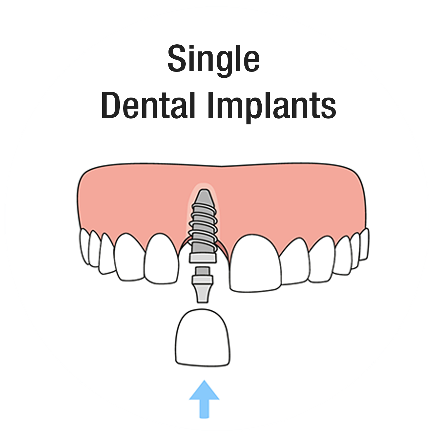 Single Dental Implant