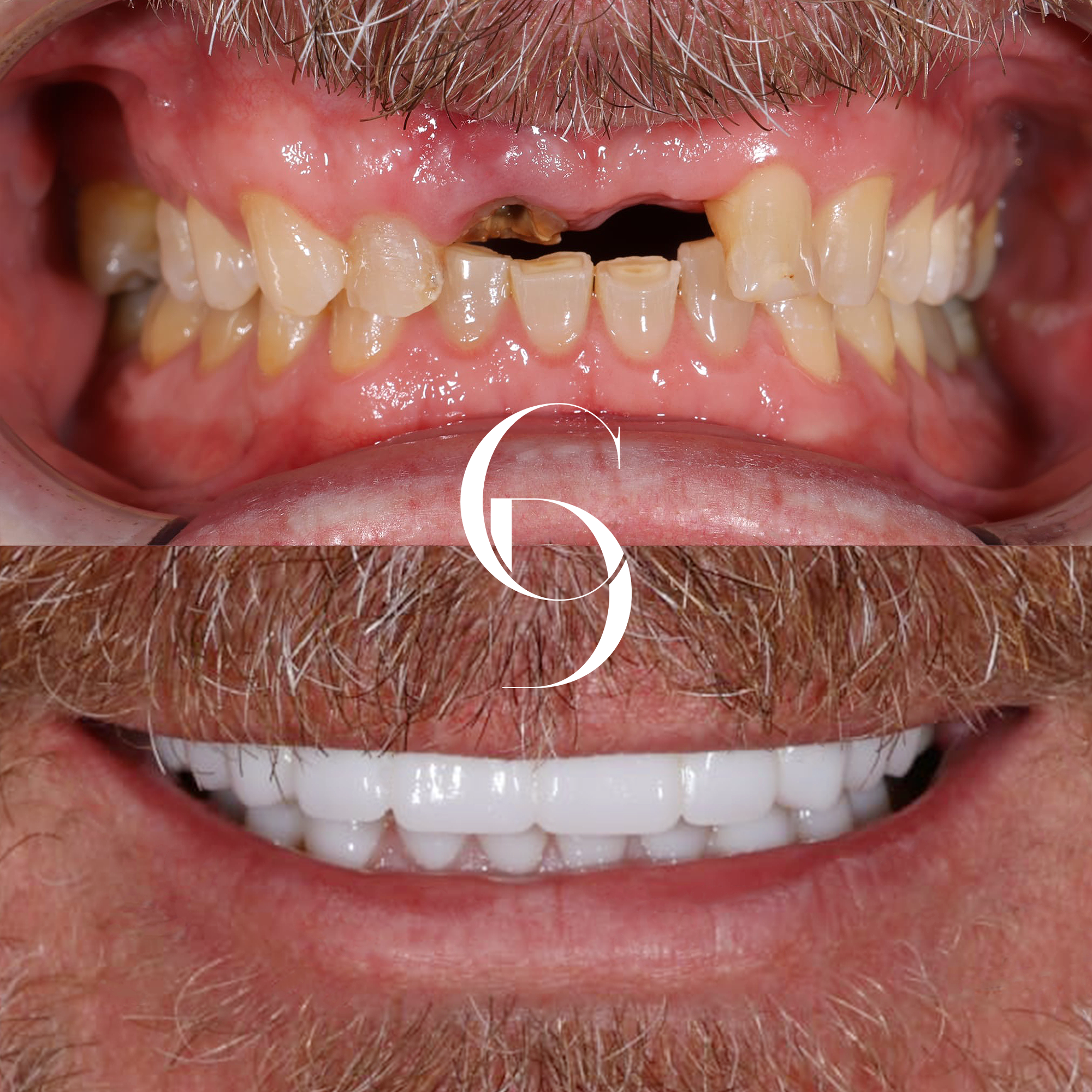 All-On-X Dental Implants