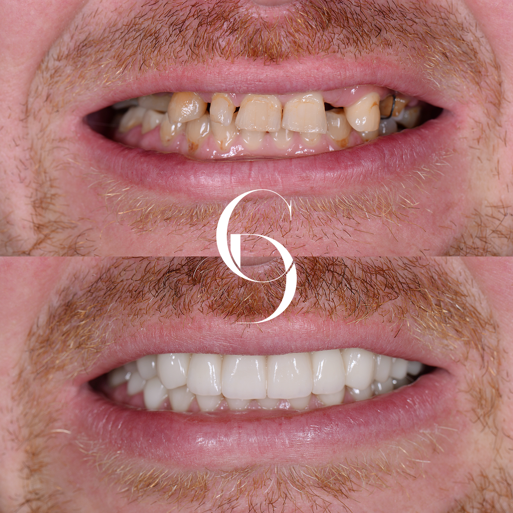 All-Teeth-On-Implants