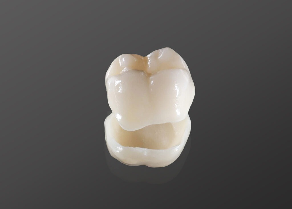 Dental crown fitted at North Ryde Dentistry