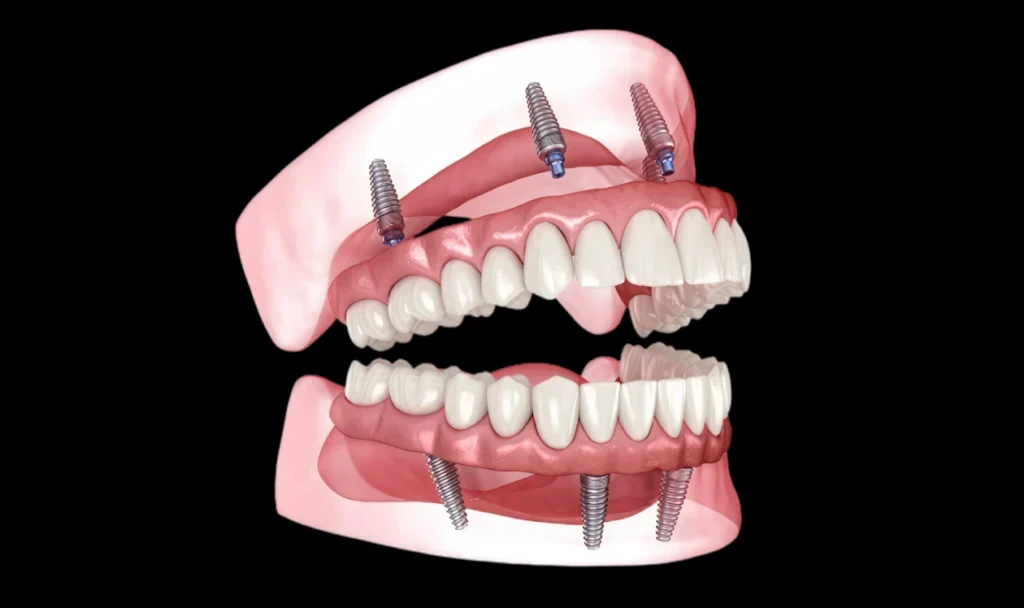Full-arch teeth on implants treatment