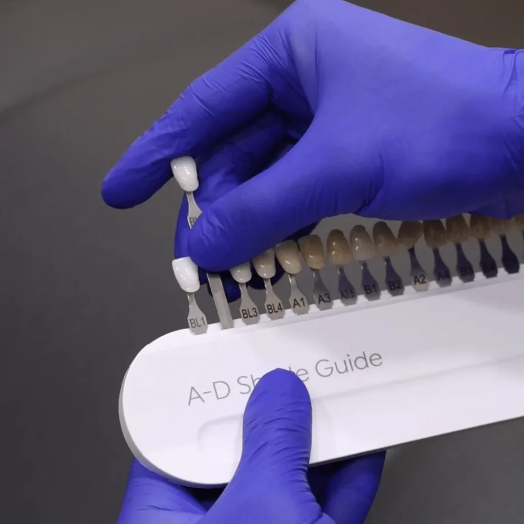Composite Veneers in North Ryde