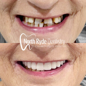 Dental Implants