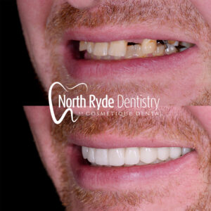 Dental Implants