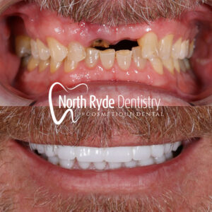 Dental Implants