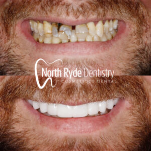 Dental Implants
