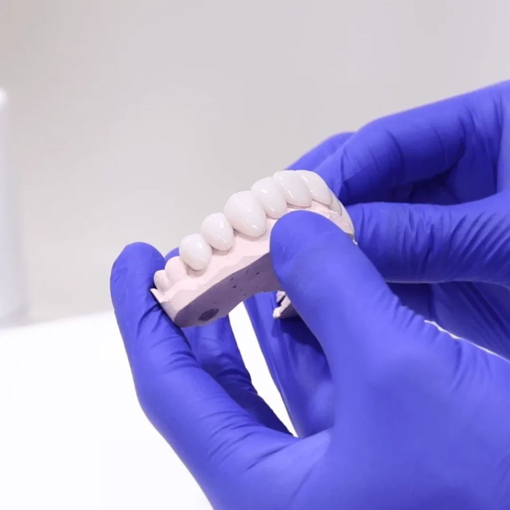 Porcelain veneers model at North Ryde Dentistry