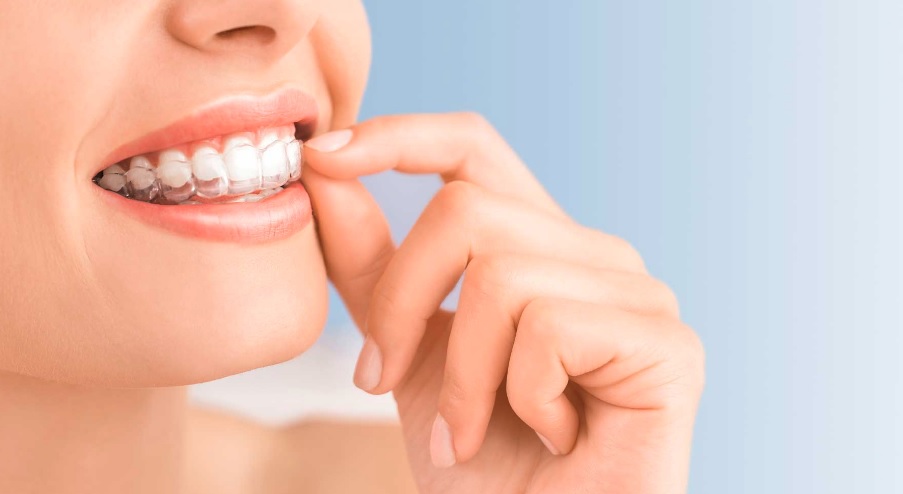 How Long Does Invisalign Treatment Take?
