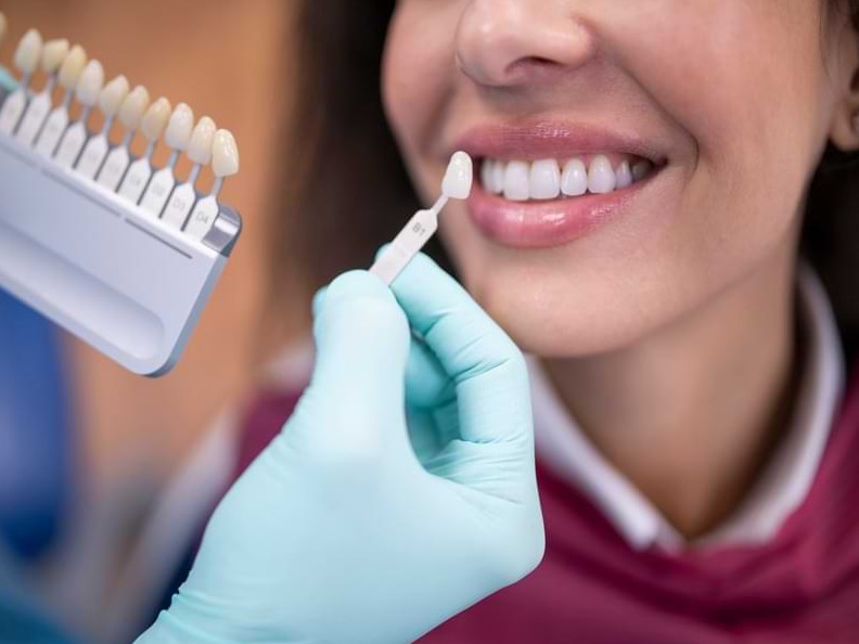 How Much Do Veneers Cost? Porcelain and Composite