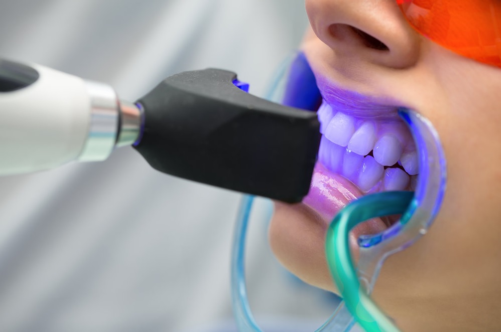 In-Chair Teeth Whitening: What to Expect