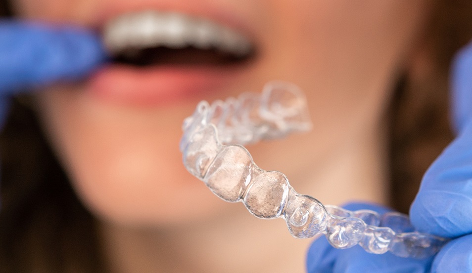 Invisalign Cost in Macquarie Park: What Is Included