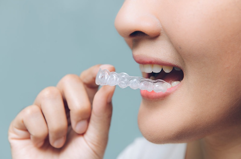 Invisalign: Pros and Cons