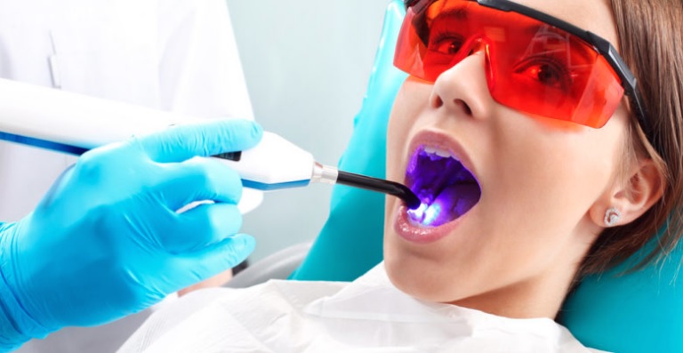 Professional vs At-Home Teeth Whitening