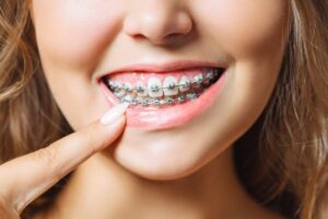 Teeth Braces: A Guide for Adults and Families